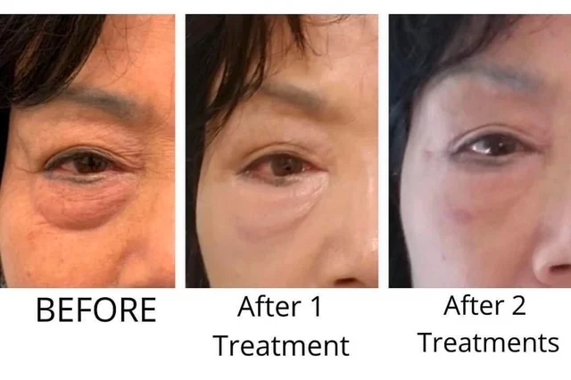 Agnes Eyes -lake-washington-medical-aesthetics-kirkland-WA