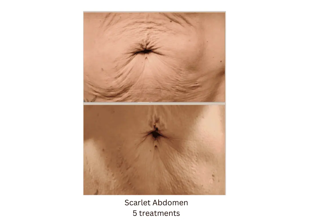 Scarlet-SRF-Abdomen-lake-washington-medical-aesthetics-kirkland-WA