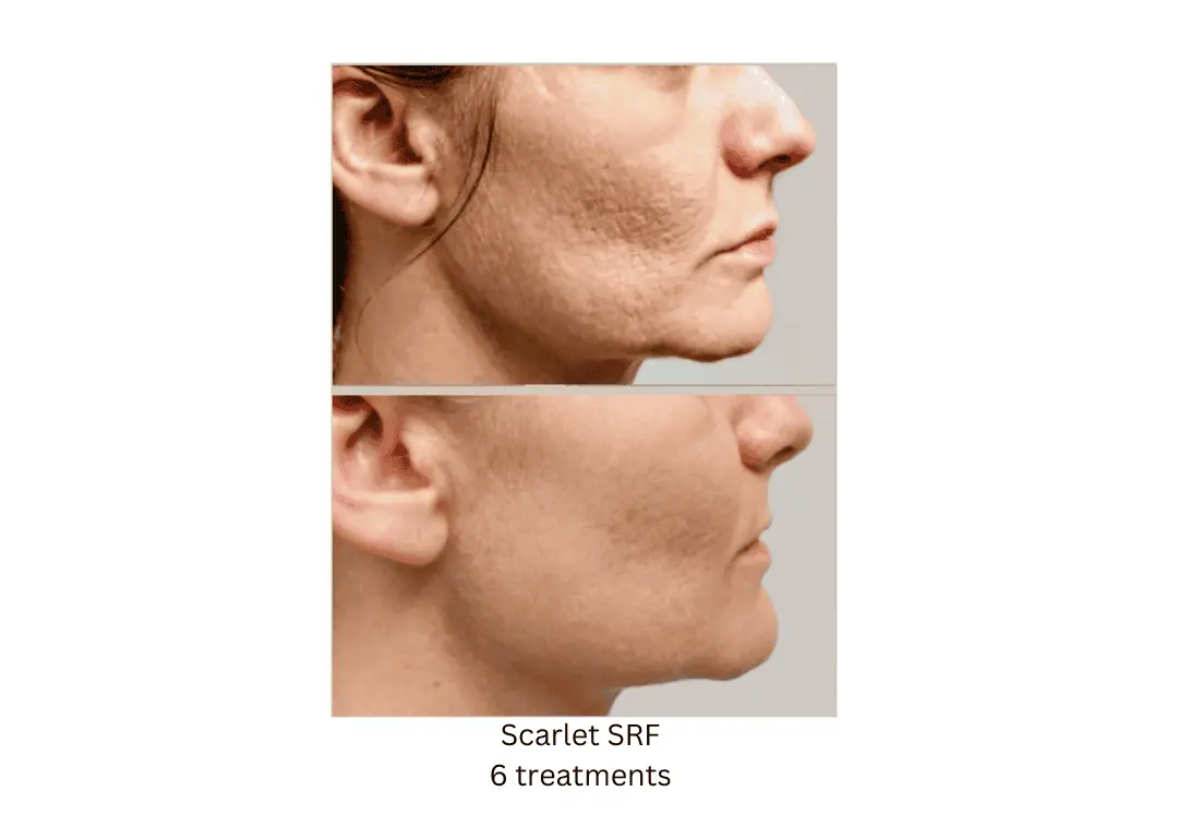 Scarlet-SRF-Face-6-treatments-lake-washington-medical-aesthetics-kirkland-WA