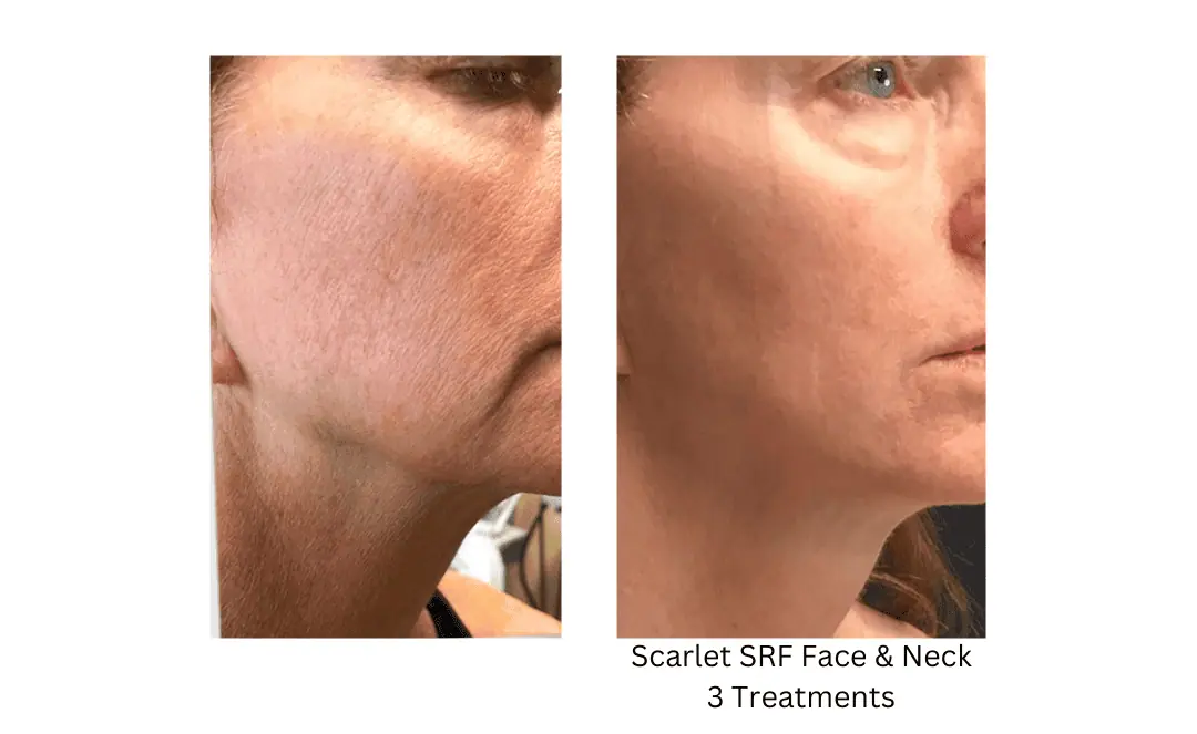 Scarlet-SRF-Face-Neck-lake-washington-medical-aesthetics-kirkland-WA