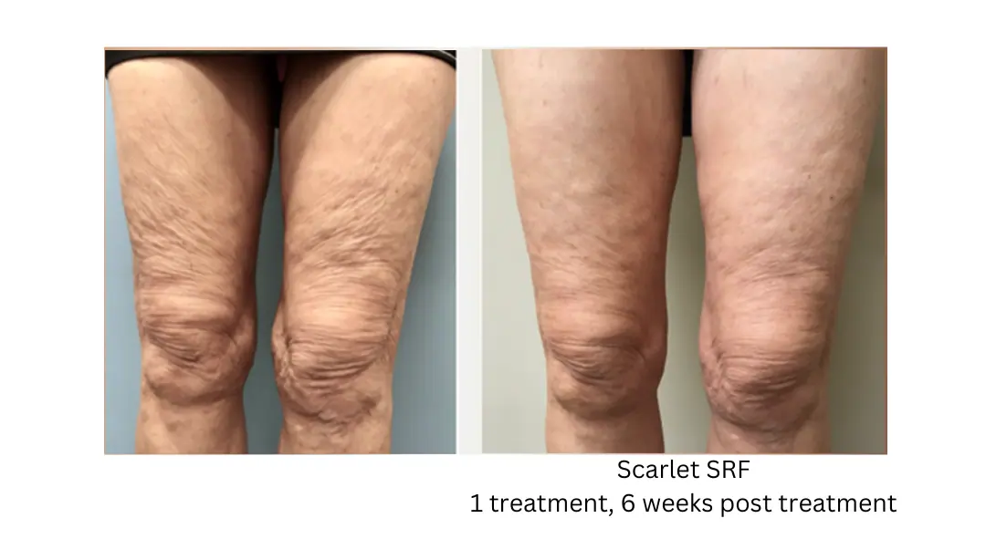 Scarlet-SRF-Thighs-lake-washington-medical-aesthetics-kirkland-WA