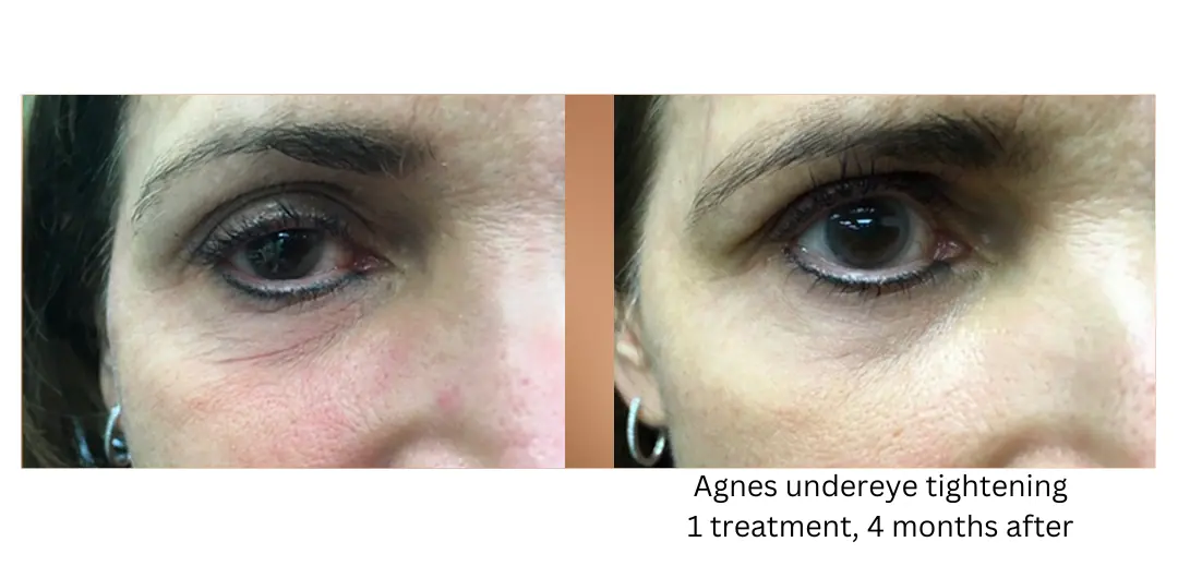 a close up of a woman's eyes-lake-washington-medical-aesthetics-kirkland-WA