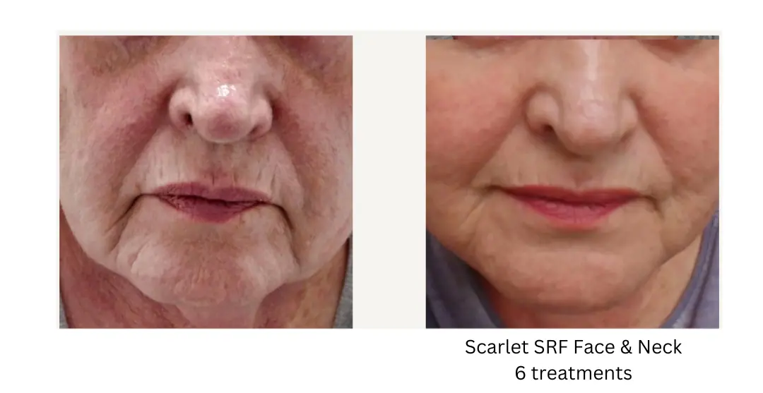 a close up of a woman's face-lake-washington-medical-aesthetics-kirkland-WA