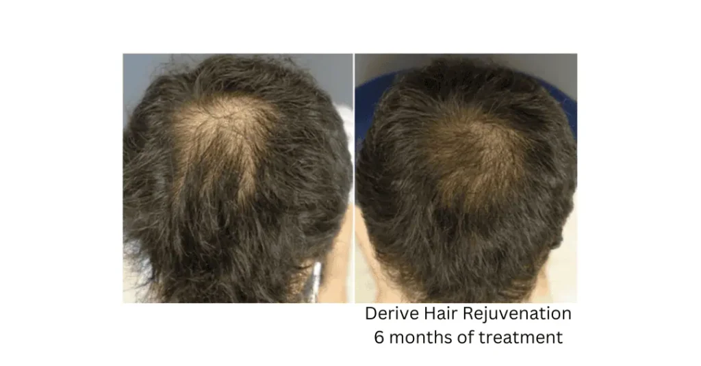 a collage of hair loss treatment-lake-washington-medical-aesthetics-kirkland-WA