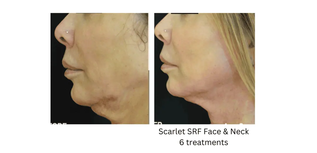 a side view of a woman's-lake-washington-medical-aesthetics-kirkland-WA