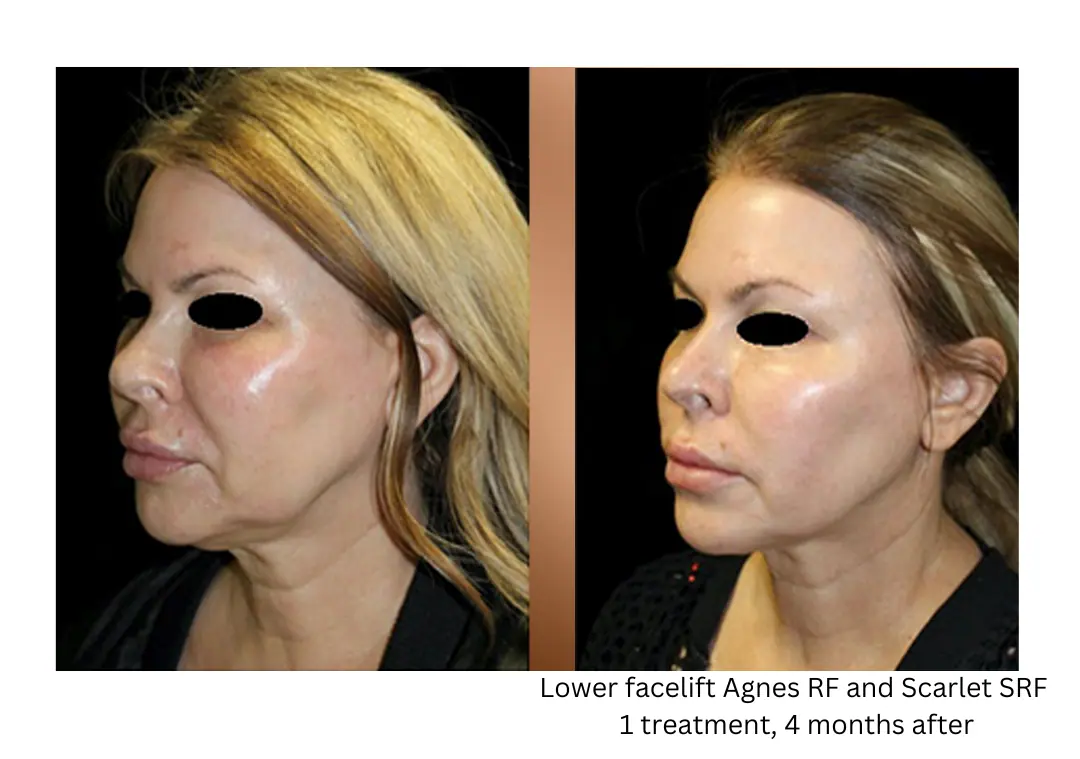 a woman with a mask on her face-lake-washington-medical-aesthetics-kirkland-WA