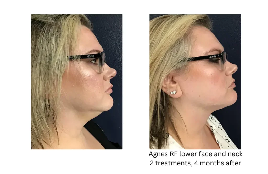 a woman with glasses and a side view of her face-lake-washington-medical-aesthetics-kirkland-WA