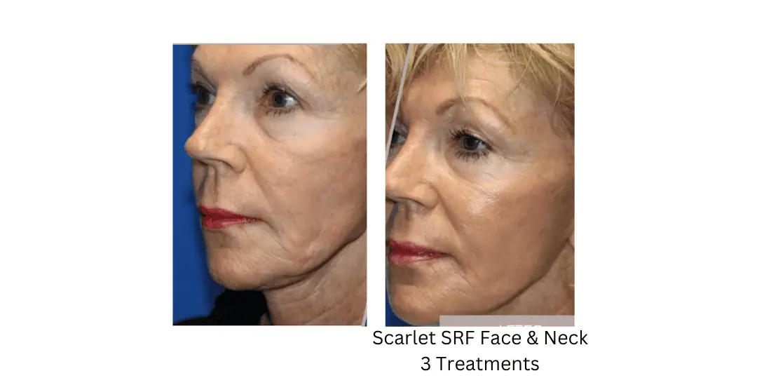 a woman's face before and after -lake-washington-medical-aesthetics-kirkland-WA