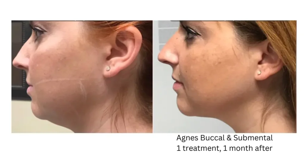 bA-lake-washington-medical-aesthetics-kirkland-WA